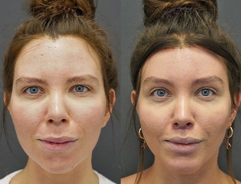 before and after buccal fat removal front view female patient Beverly Hills, CA