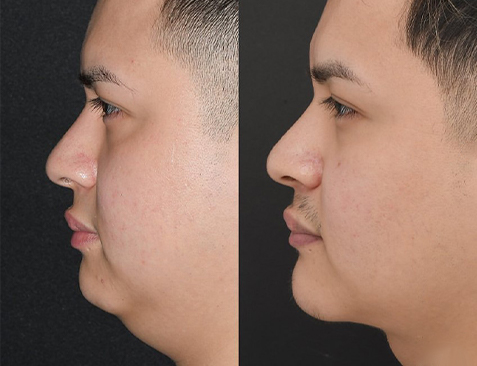 before and after chin reduction right side male patient Beverly Hills, CA