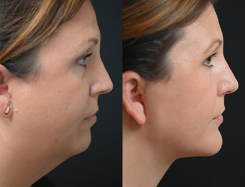 before and after chin reduction right side female patient Los Angeles, CA