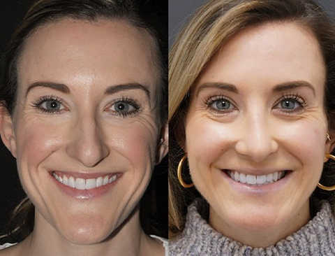before and after chin reduction front view female patient Los Angeles, CA