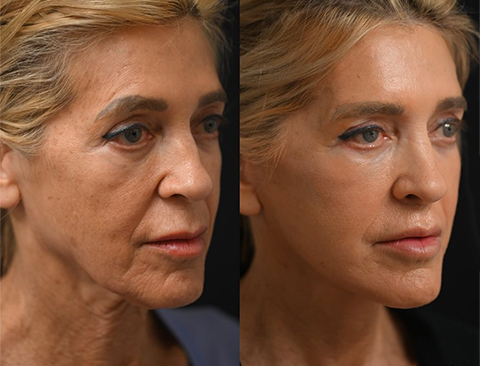before and after facial fat transfer right angle female patient Beverly Hills, CA