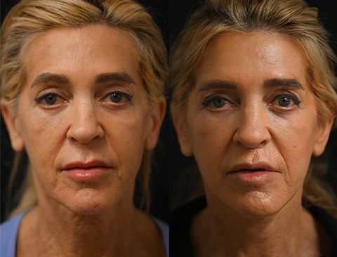 before and after facial fat transfer front view female patient Beverly Hills, CA
