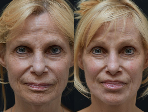 before and after facial fat transfer front view female patient Los Angeles, CA