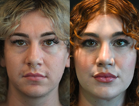 before and after facial feminization front view female patient Beverly Hills, CA