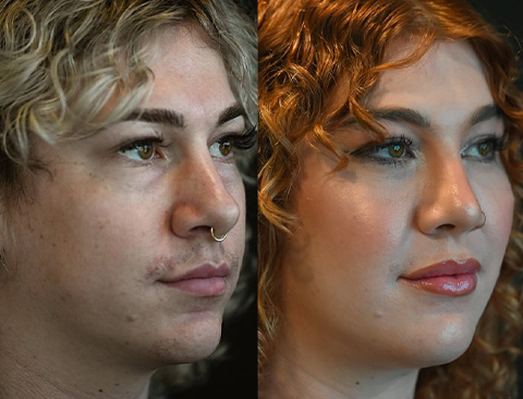 before and after facial feminization right angle female patient Los Angeles, CA