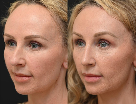 before and after forehead reduction left angle female patient Beverly Hills, CA