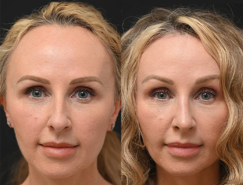 before and after forehead reduction front view female patient Los Angeles, CA