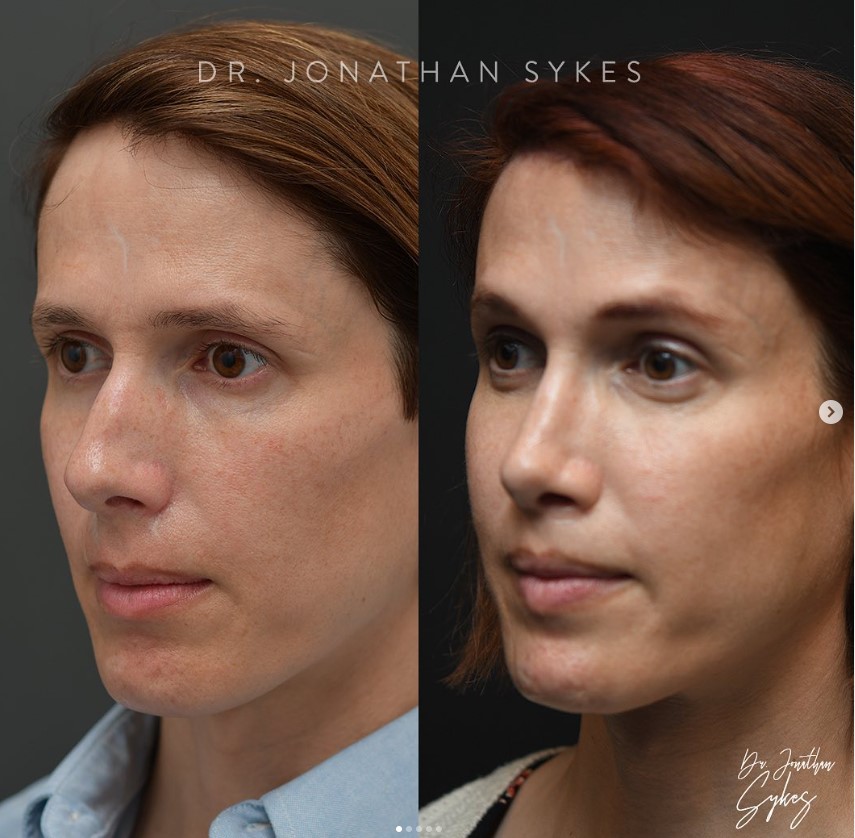 before and after gender affirming left angle female patient Beverly Hills, CA