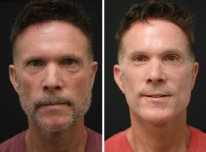 Sykes-Homepage-gallery-Facial-Rejuventation