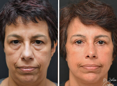 Sykes-Homepage-gallery-blepharoplasty
