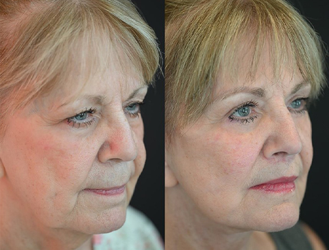 before and after lip lift right angle female patient Beverly Hills, CA