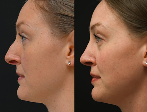 before and after revision rhinoplasty left side view female patient Los Angeles, CA