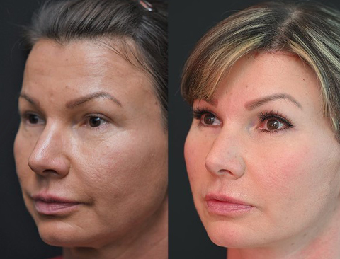 before and after bony brow lift left angle view female patient Los Angeles, CA