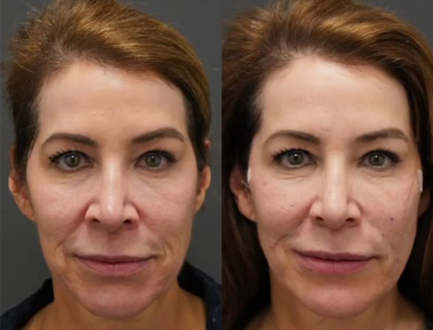 before and after PDO Threadlifts front view female patient Los Angeles, CA