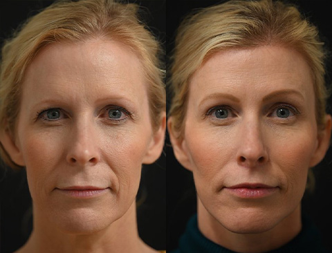 before and after upper blepharoplasty front view female patient Los Angeles, CA